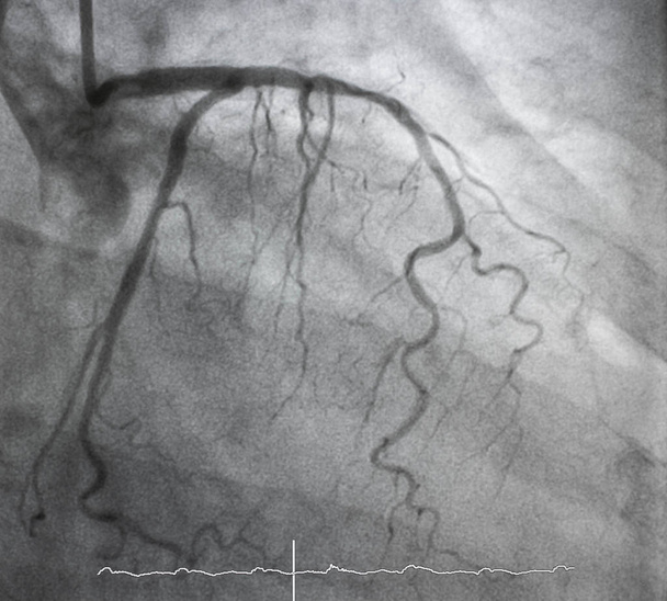 Angiografia coronariana, angiografia coronariana esquerda
 - Foto, Imagem