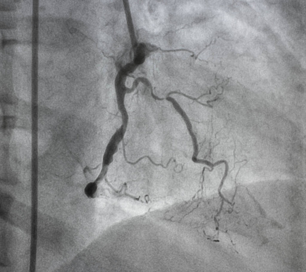 Coronaire angiografie, rechter coronaire angiografie - Foto, afbeelding