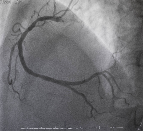 Coronary angiography , right coronary angiography - Photo, Image