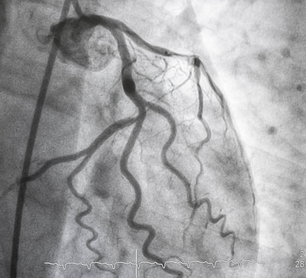Angiographie coronarienne, Angiographie coronarienne gauche
 - Photo, image