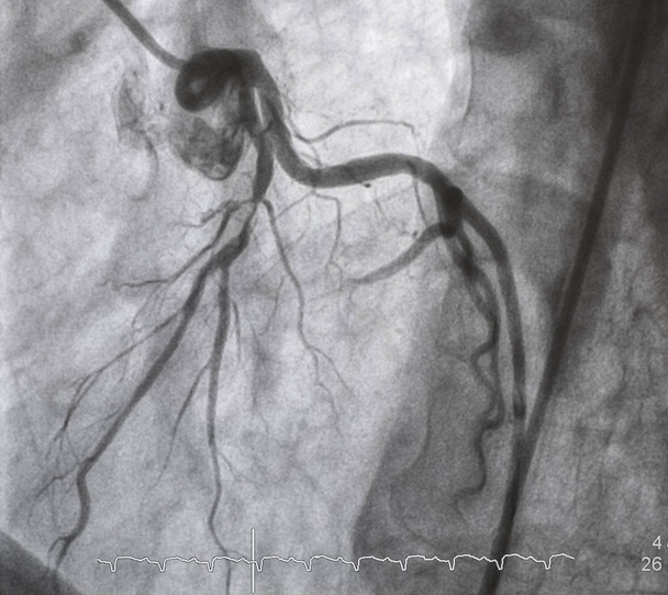 Coronary angiography , Left coronary angiography - Photo, Image