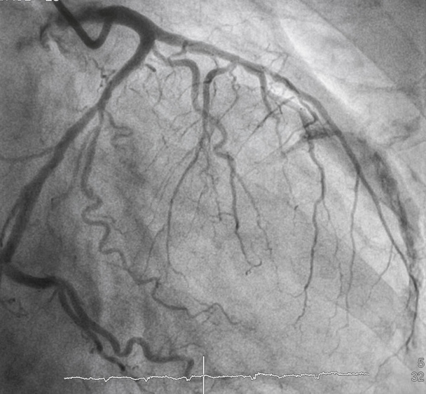 Angiografía coronaria, angiografía coronaria izquierda
 - Foto, Imagen