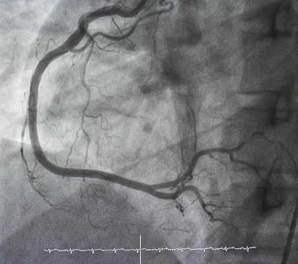 Coronaire angiografie, rechter coronaire angiografie - Foto, afbeelding