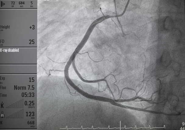Angiographie coronarienne, angiographie coronarienne droite - Photo, image