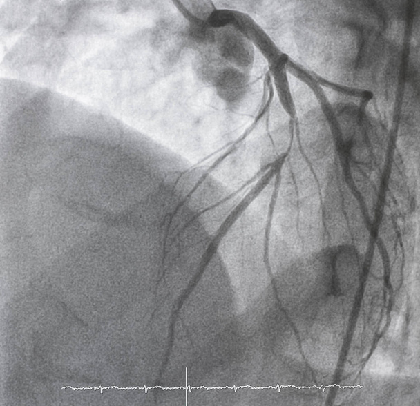 Coronaire angiografie, linker coronaire angiografie - Foto, afbeelding