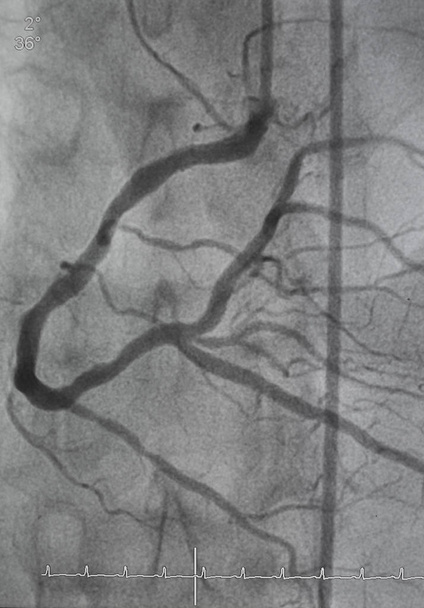 Angiografia coronariana, angiografia coronária direita - Foto, Imagem