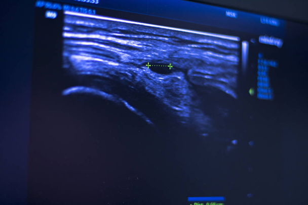 EPI dry needling ultrasound scan - Photo, Image
