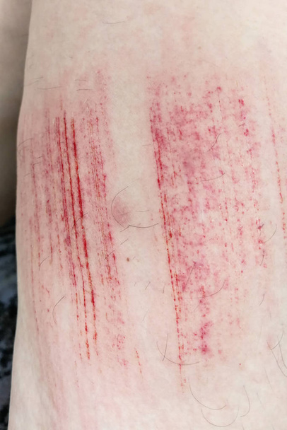 Bleus douloureux avec du sang sur la cuisse en raison d'une abrasion accidentelle
 - Photo, image