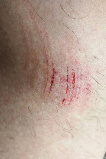 Moretones dolorosos con sangre en el muslo debido a abrasión accidental
 - Foto, imagen