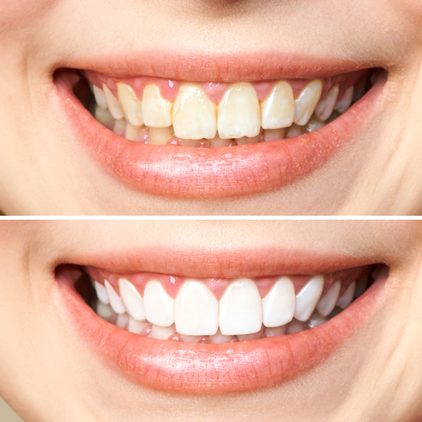 vrouwelijke tanden voor en na het bleken. Over witte achtergrond. Tandheelkundige kliniek patiënt. Afbeelding symboliseert mondverzorging tandheelkunde, stomatologie - Foto, afbeelding