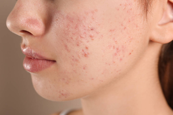 Teenage girl with acne problem on beige background, closeup - Photo, Image