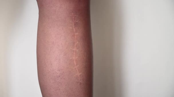 La cicatrice sur la jambe. Fracture osseuse ou ablation tumorale. Récupération
 - Séquence, vidéo