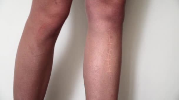 A cicatriz na perna. Fratura óssea ou remoção do tumor. Recuperação
 - Filmagem, Vídeo