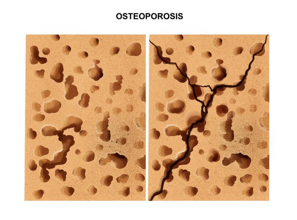 ilustración del proceso de osteoporosis
 - Foto, Imagen