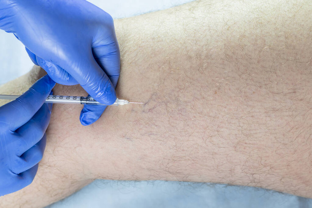doctor examines a man s leg. there is varicose veins - 写真・画像