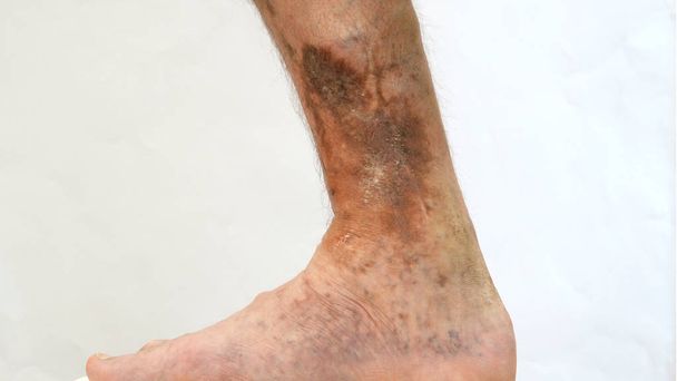 Ihmisen ihosairaus. Henkilö jalka, joka vaikuttaa ihotautilääkäri
 - Valokuva, kuva