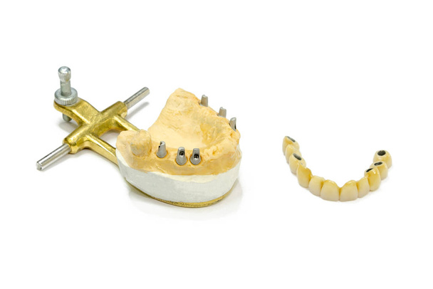 dental implants. dental ceramic crowns on implants. artificial teeth on abutments. ceramic crowns on artificial roots. isolated - Photo, Image