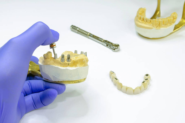 prosthetics on dental implants. concept of orthopedic dentistry. ceramic bridge on implants. dentist's hand holds a plaster jaw with dental abutments - 写真・画像