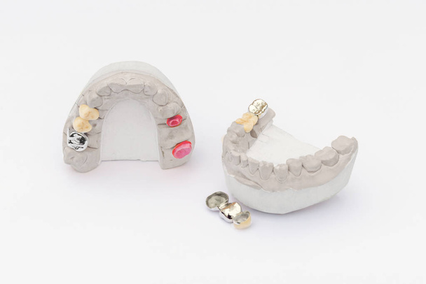Coroas dentárias isoladas sobre um fundo branco. Dentista ortopédico ry background. pontes e coroas dentárias cerâmico-metálicas
 - Foto, Imagem