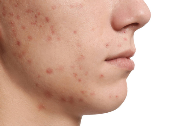 Teen guy with acne problem on white background, closeup - Foto, imagen