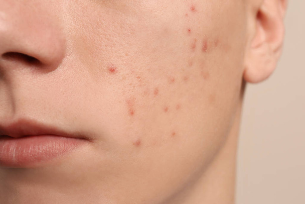 Teen guy with acne problem on beige background, closeup - Photo, Image