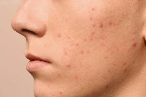 Teen guy with acne problem on beige background, closeup - Photo, Image