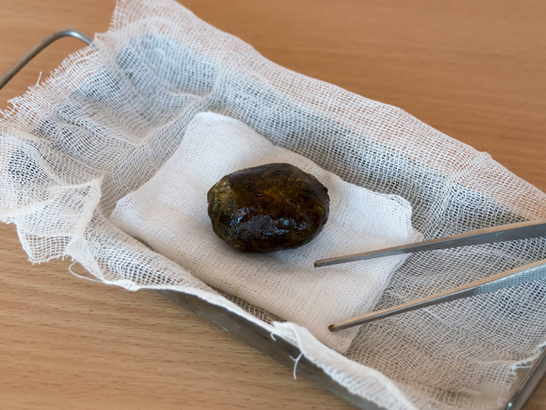 Large gallstone close-up. Extracted during laparoscopic cholecystectomy, surgery to remove the gallbladder. Complications of gallstone disease. - Photo, Image