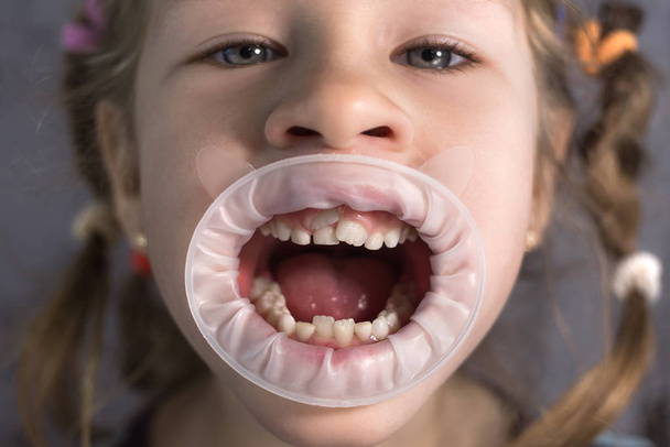 Adult permanent teeth coming in front of the child's baby teeth: - Photo, Image