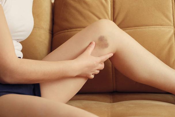 Young woman examines an injured leg on the couch - 写真・画像
