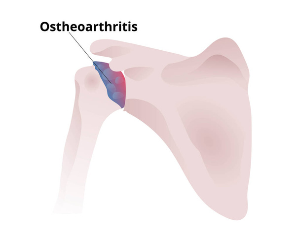 Иллюстрация остеоартрита плеч
 - Вектор,изображение