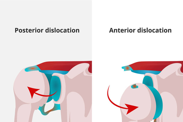 Ilustração do vetor de deslocamento anterior e posterior do ombro
 - Vetor, Imagem