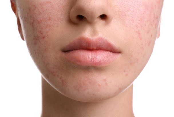 Teenage girl with acne problem on white background, closeup - Foto, imagen