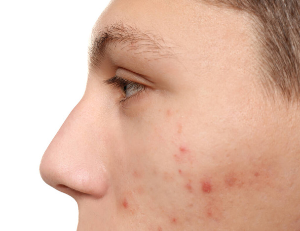 Teen guy with acne problem on white background, closeup - Φωτογραφία, εικόνα