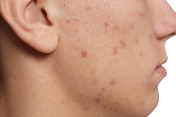 Teen guy with acne problem on white background, closeup - Fotografie, Obrázek