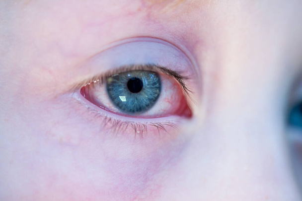 Closeup of irritated red bloodshot eye - conjunctivitis - Фото, зображення