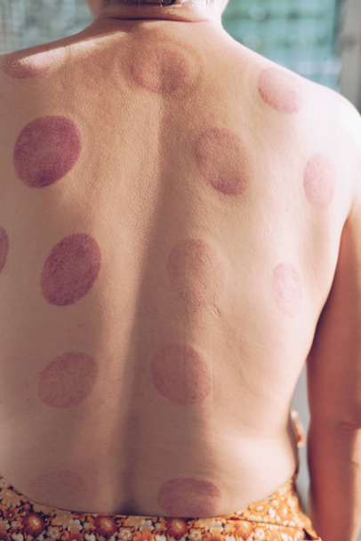 marca de parche de sangre en la espalda después del tratamiento de masaje con ventosas chinas
 - Foto, Imagen