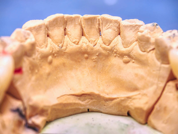 Corona dentale in metallo-ceramica è provato su un modello di gesso
 - Foto, immagini