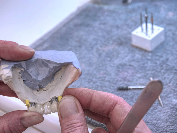 Metaal-keramische tandheelkundige kroon wordt geprobeerd op een gips model - Foto, afbeelding