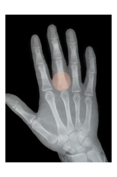 bokser breuk, x-ray - Foto, afbeelding