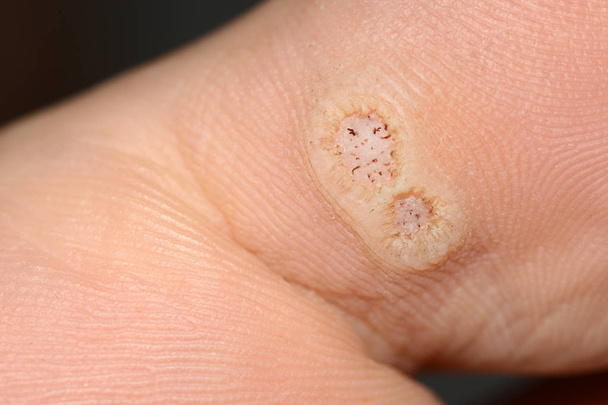 Zbliżenie dwóch brodawek plantacyjnych na palcu spowodowanych przez wirusa brodawczaka ludzkiego lub Hpv - Zdjęcie, obraz