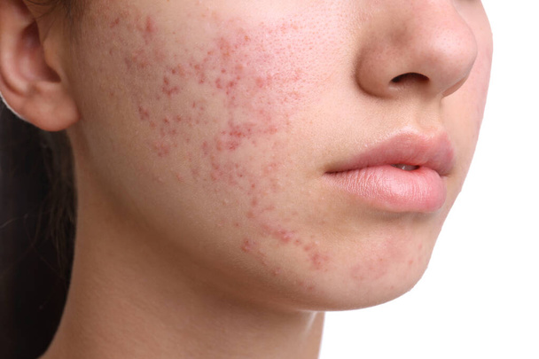 Teenage girl with acne problem on white background, closeup - Φωτογραφία, εικόνα