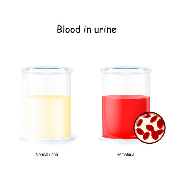 Orina normal y sangrienta. dos vasos con orina. Hematuria es el
 - Vector, Imagen