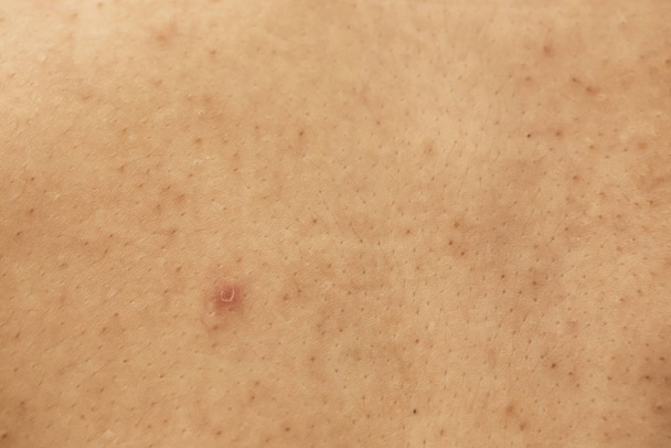 problematische huid van de vrouw, littekens van acne, vette huid en poriën, donkere vlekken en mee-eters op het gezicht - Foto, afbeelding