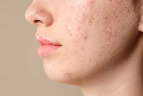 Teenage girl with acne problem on beige background, closeup - Фото, зображення