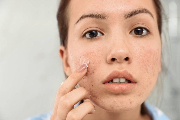 Teen girl applying acne healing patch, closeup - Φωτογραφία, εικόνα