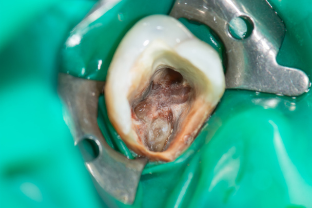 endodontische Behandlung der Zähne aus nächster Nähe. Reinigung der Wurzeln von - Foto, Bild