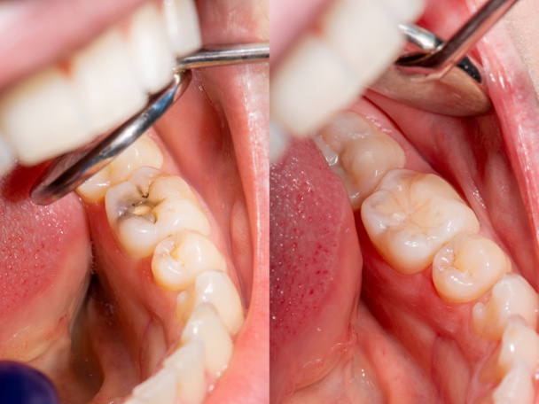 Karieksia ja hammassairauksia. Täyttö hampaiden komposiittivalolla
 - Valokuva, kuva