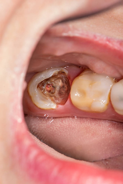 Caries and tooth disease. Filling with a dental composite photop - Photo, Image