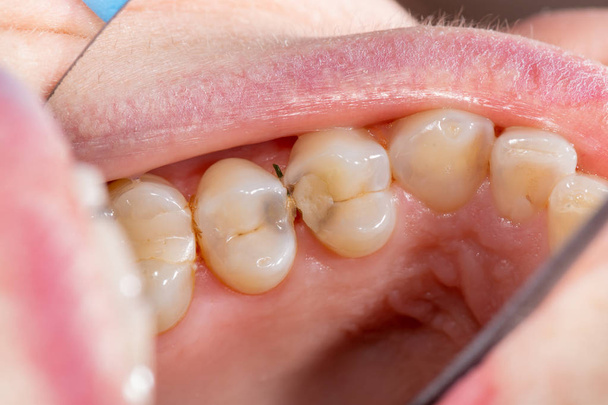 虫歯や歯。歯科用複合フォトップで満たす - 写真・画像