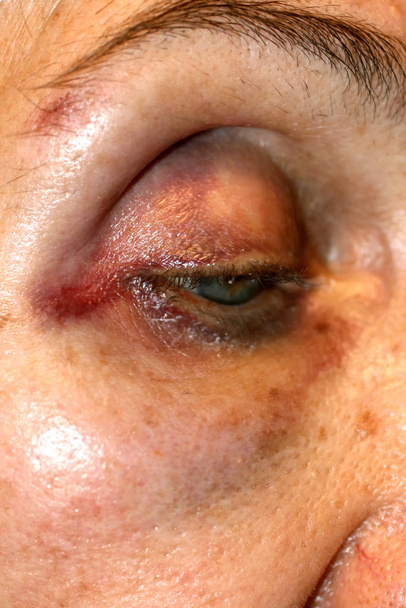 Un bleu près de l'œil. Hématome sur le visage à cause d'un coup. Lésion oculaire
. - Photo, image